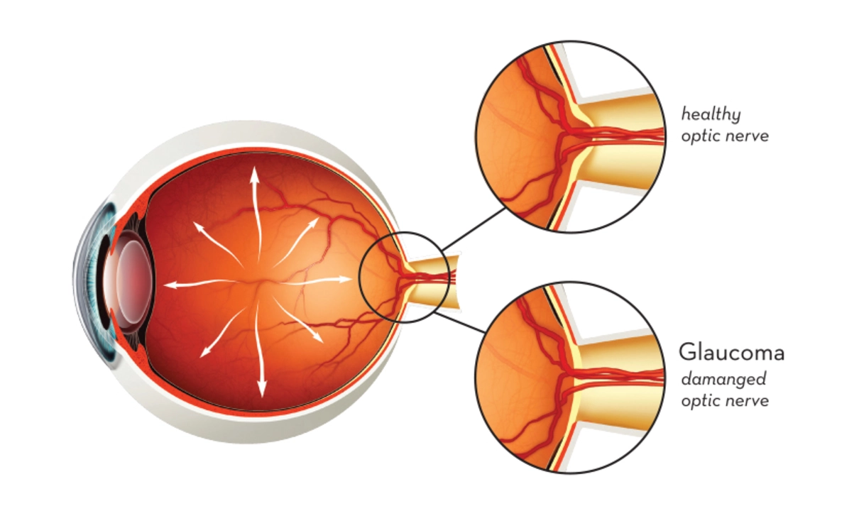 The Impact of Betaxolol on Glaucoma Progression