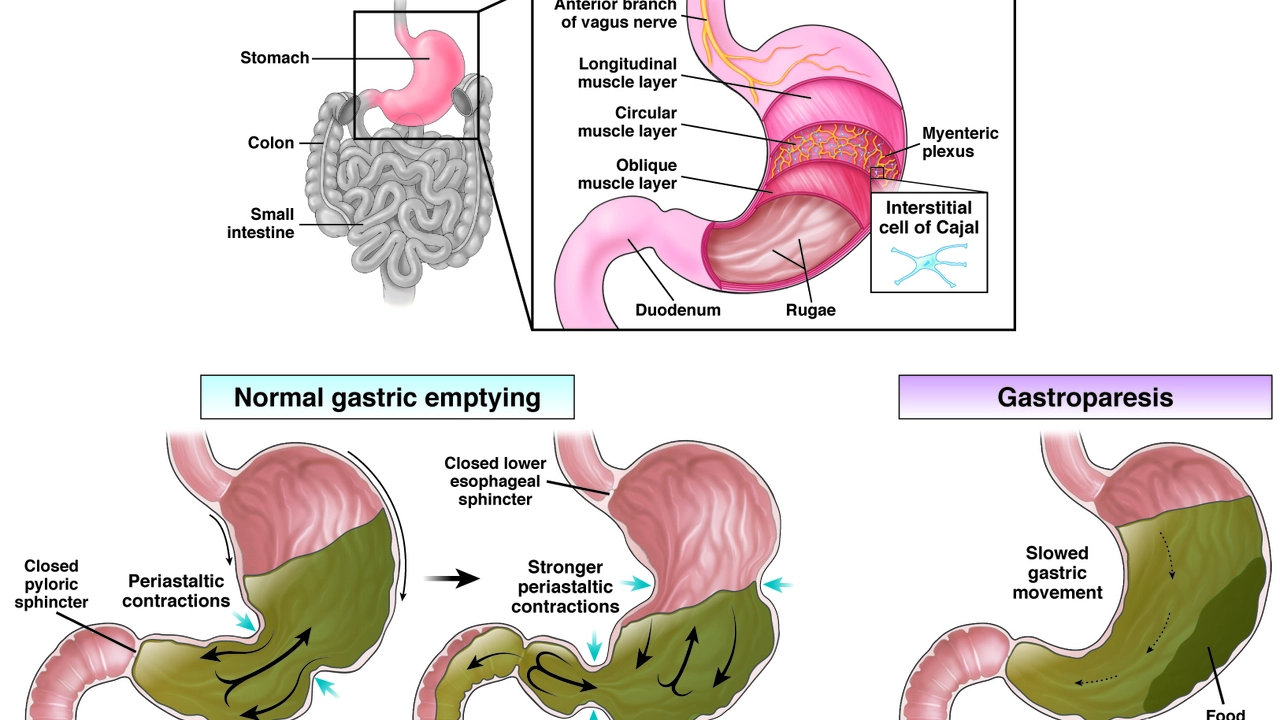 Diabetic Gastroparesis: How to Cope with the Challenges